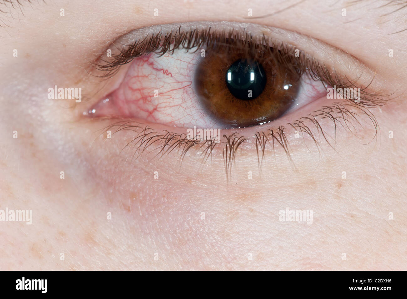 Bloodshot Eye High Resolution Stock Photography and Images Alamy