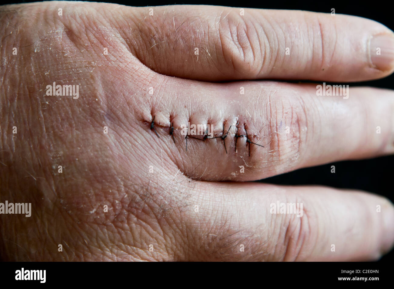 Seven non-dissolvable stitches (sutures) closing a surgical incision wound on a man's finger Stock Photo