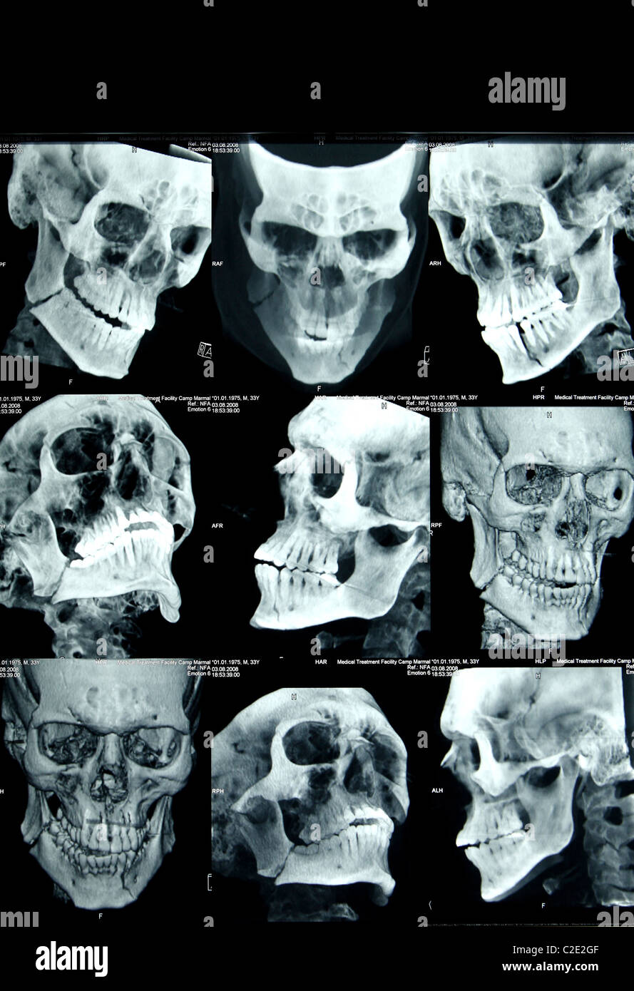 CT scans of a head, Mazar-e Sharif, Afghanistan Stock Photo