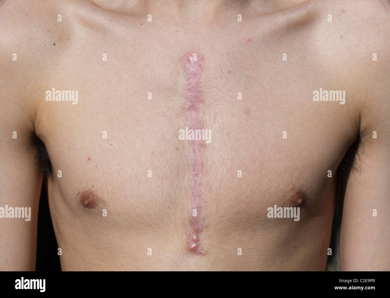 Scar from median sternotomy hi-res stock photography and images - Alamy