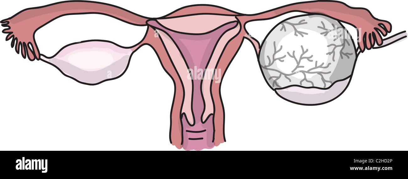 Ovarian cyst illustration Stock Photo