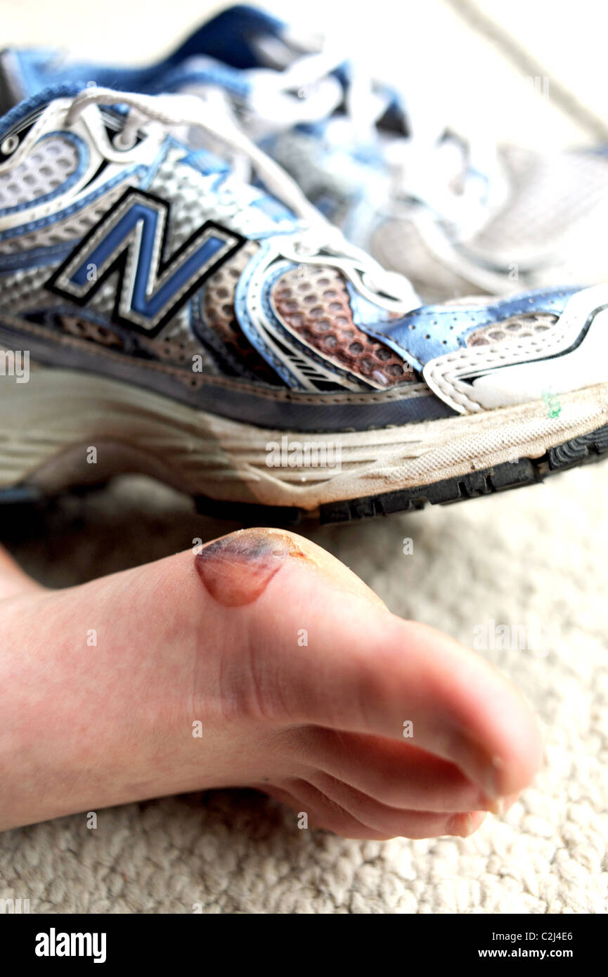 Blister foot hires stock photography and images Alamy