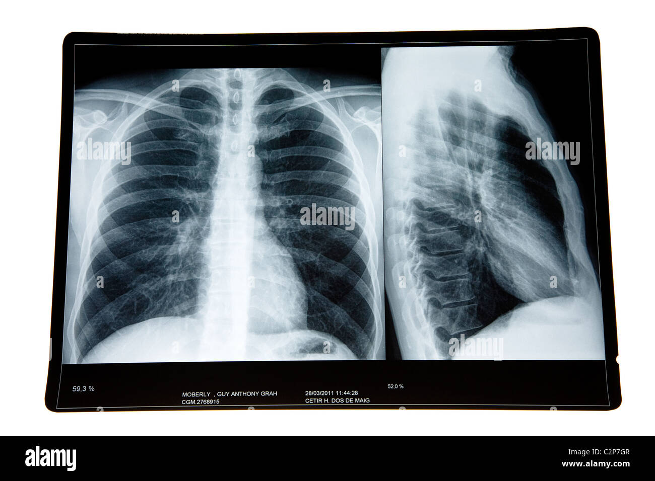 X-ray of lungs Stock Photo