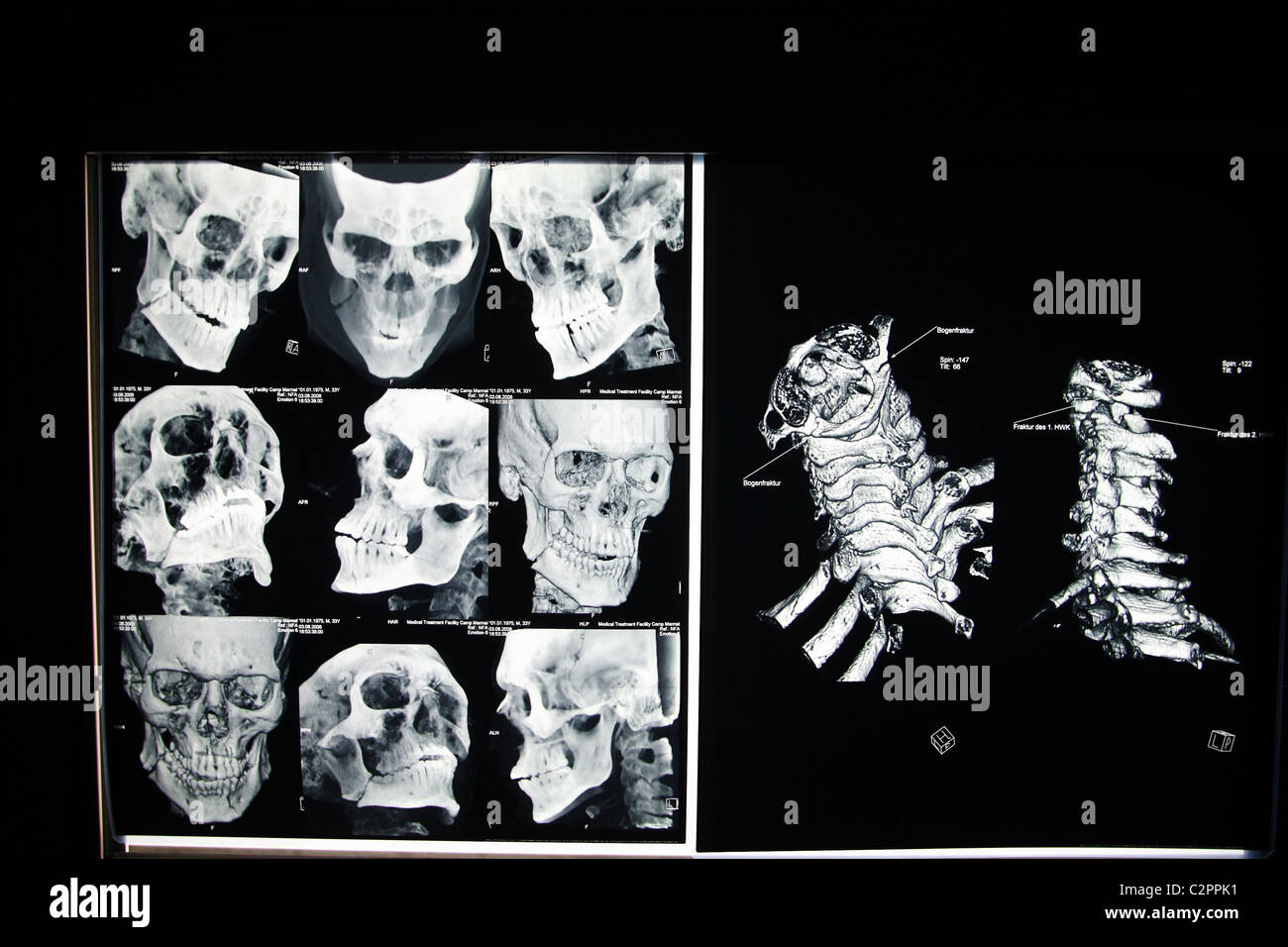 CT scans of a head and spine, Mazar-e Sharif, Afghanistan Stock Photo