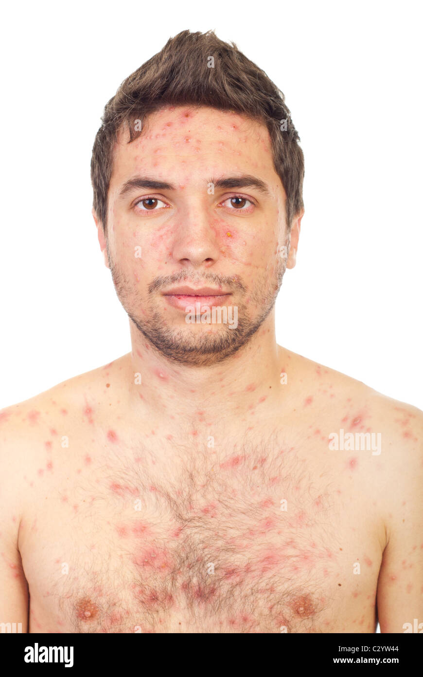 Chicken Pox Rash Adults