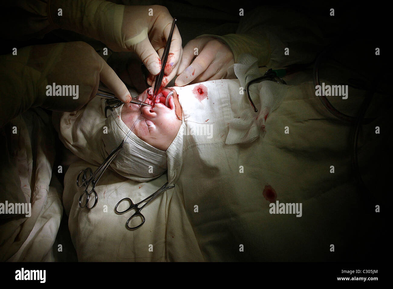 BABY UNDERGOES OPERATION TO MEND HIS CLEFT LIP . HE WAS OPERATED ON BY UK SURGEON OLIVER FENTON . ROMANIA . Stock Photo