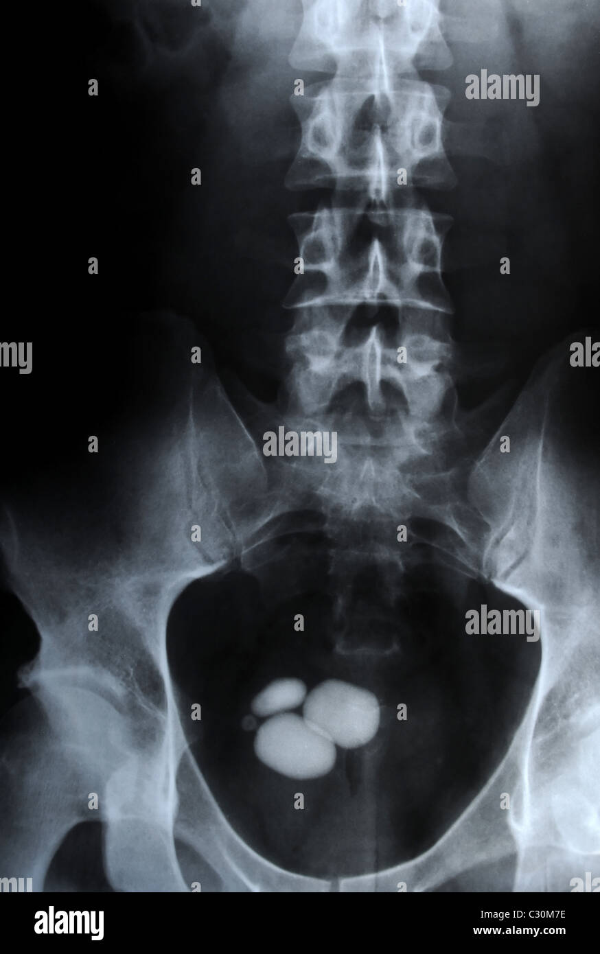 authentic x-ray picture of kidney stones in urinary bladder - ureterolithiasis Stock Photo