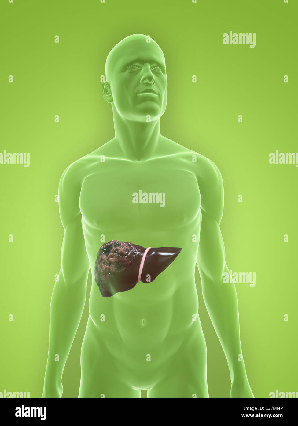liver cancer Stock Photo