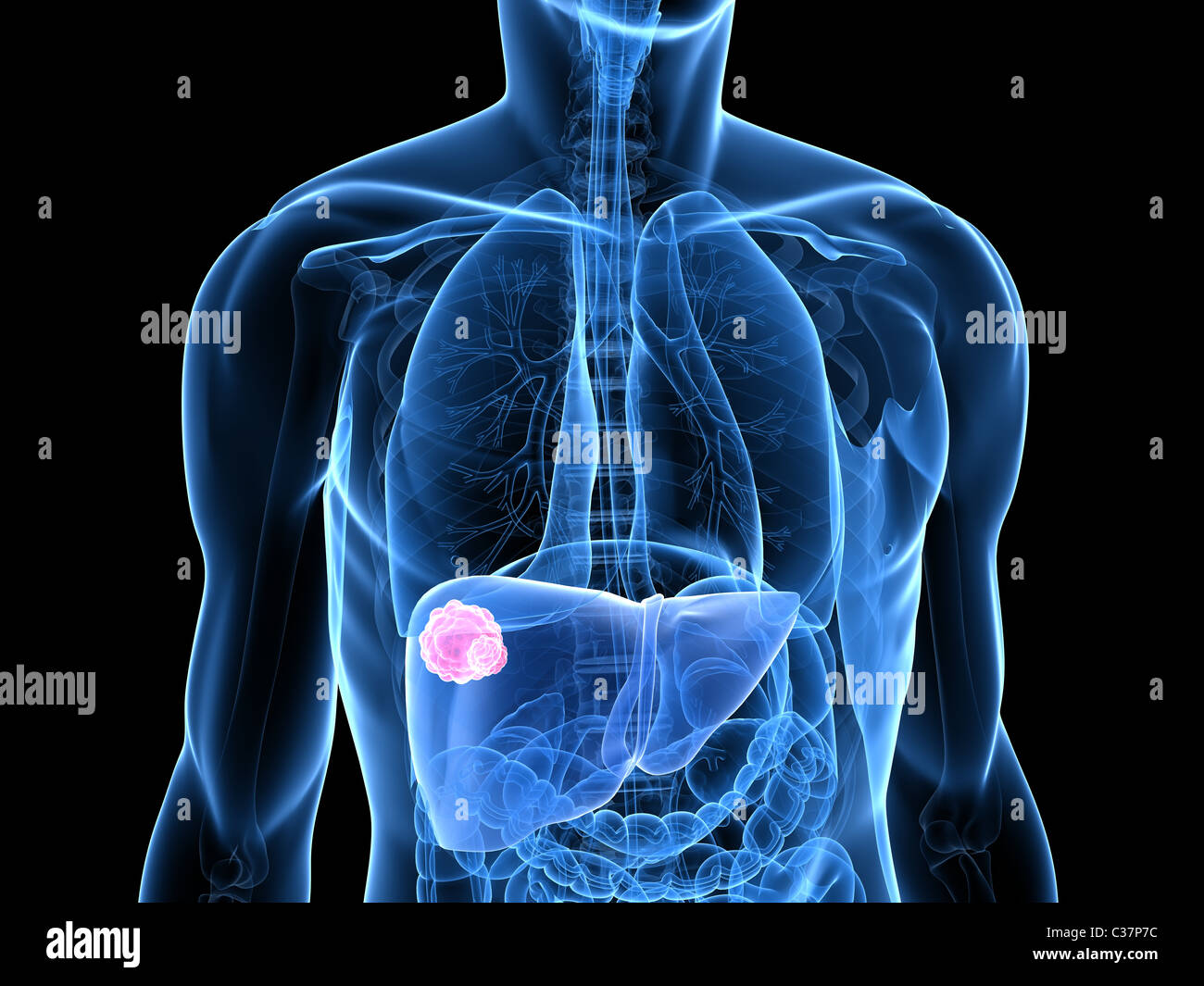 Liver cancer hi-res stock photography and images - Alamy