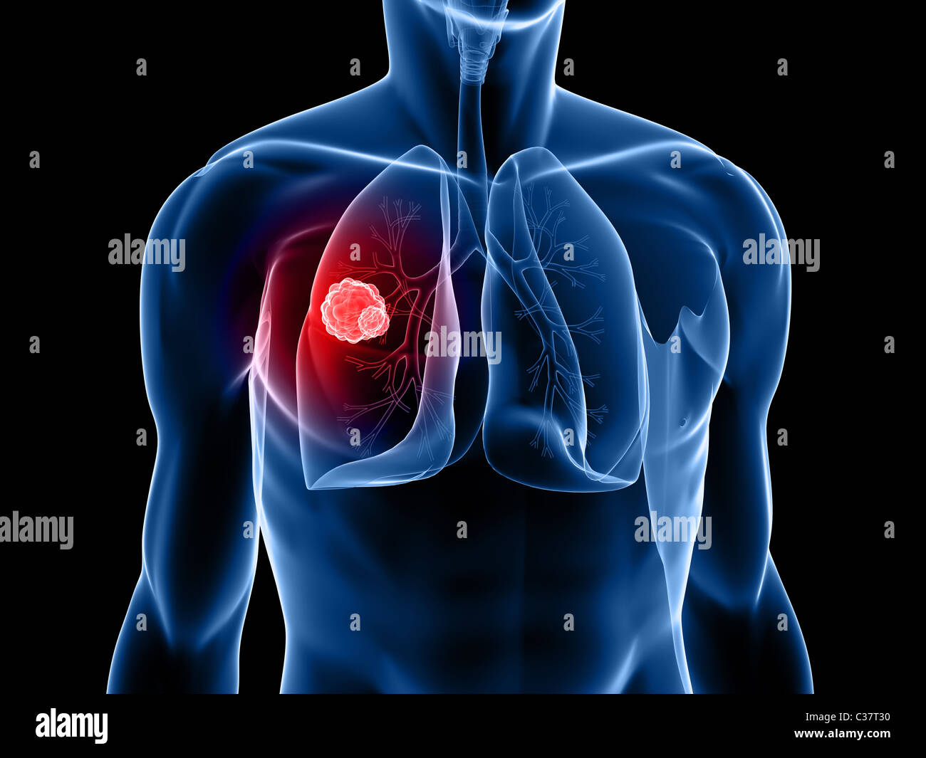 Illustration man lung cancer hi-res stock photography and images - Alamy