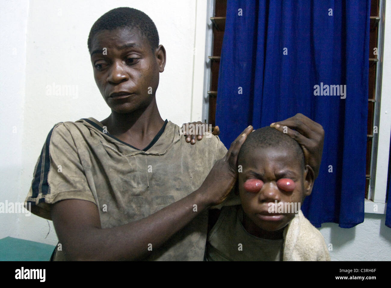 pediatric care,Betou hospital MSF,Republic of Congo; Conjonctivite grave suite à des soins indigènes chez des pygmés Stock Photo