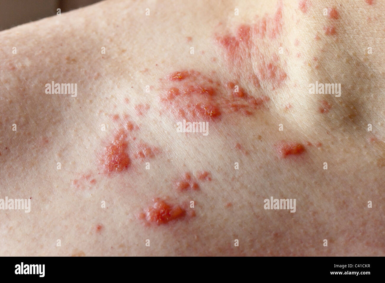 Poison Ivy Rash. An itchy red rash of poison ivy on a man's neck and shoulder. Stock Photo