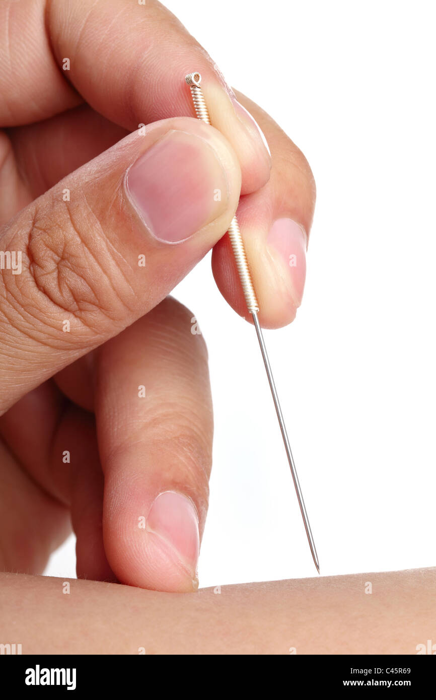 Acupuncture on skin,Closeup. Stock Photo