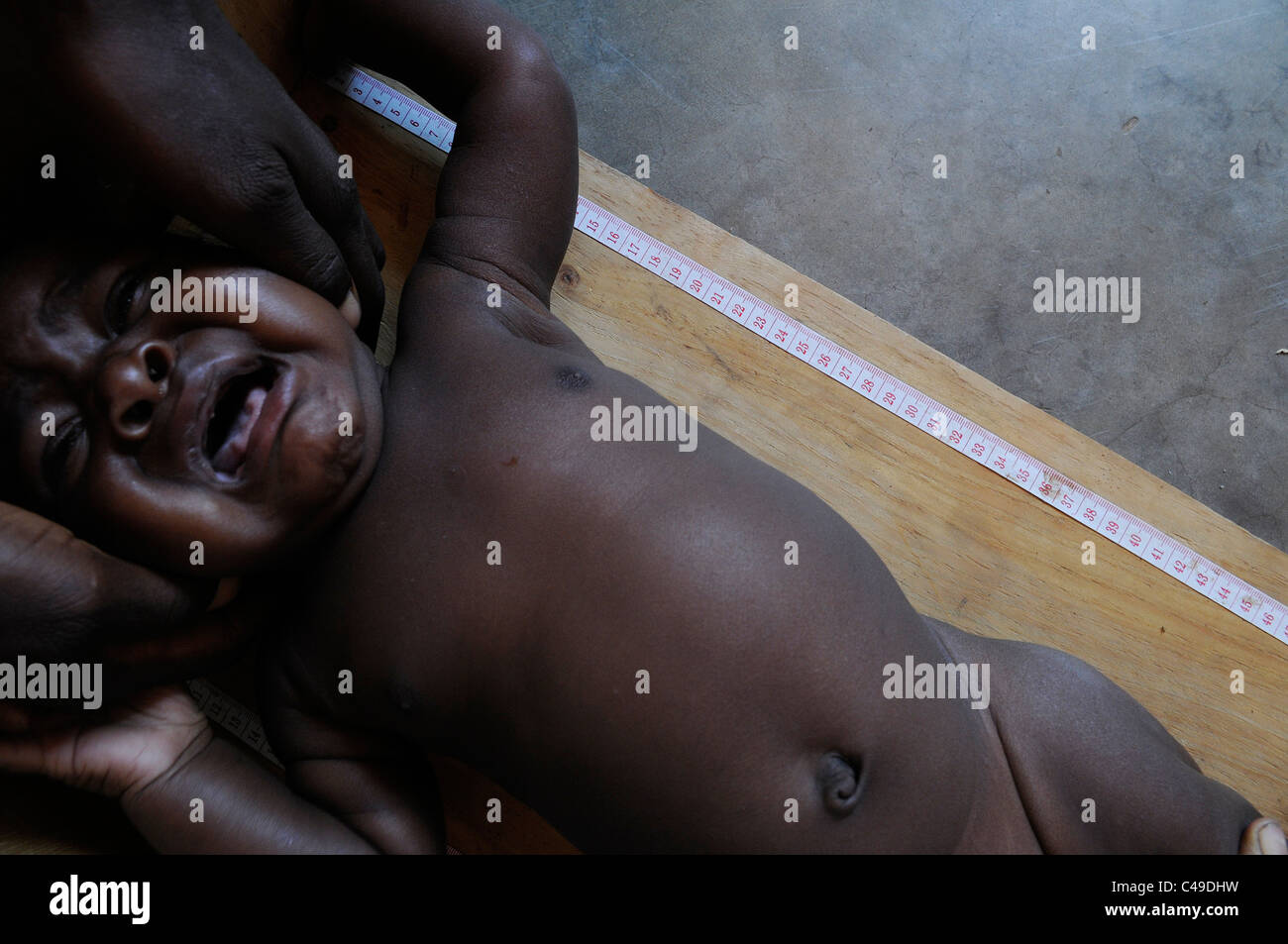 A toddler is being screened for malnutrition at a medical center in Malawi Africa Stock Photo