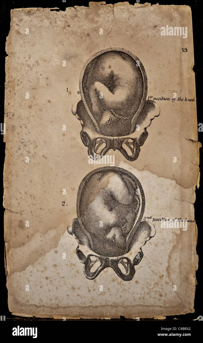This is the two positions of an infant while in the uterus. copyright 1844 Stock Photo