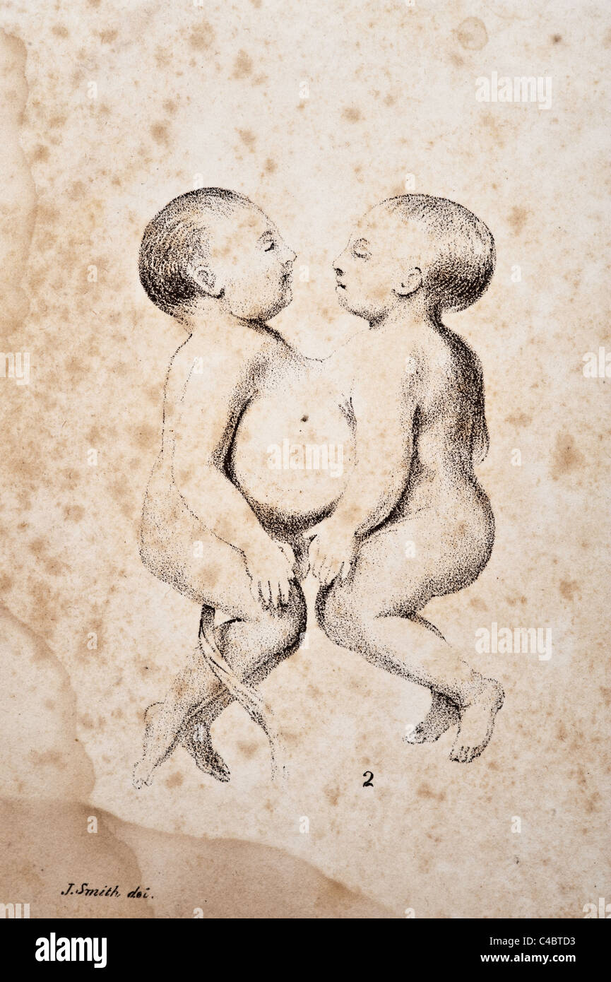 Illustration of Human Conjoined Twins copyright 1844 Stock Photo