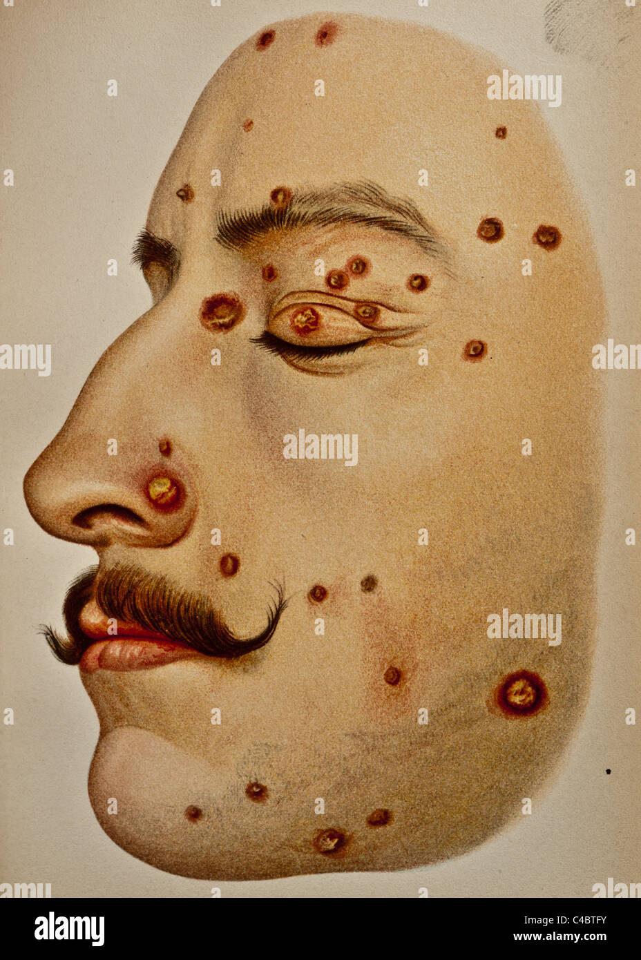 Illustration of Pustules on the Human Face copyright 1898 Stock Photo