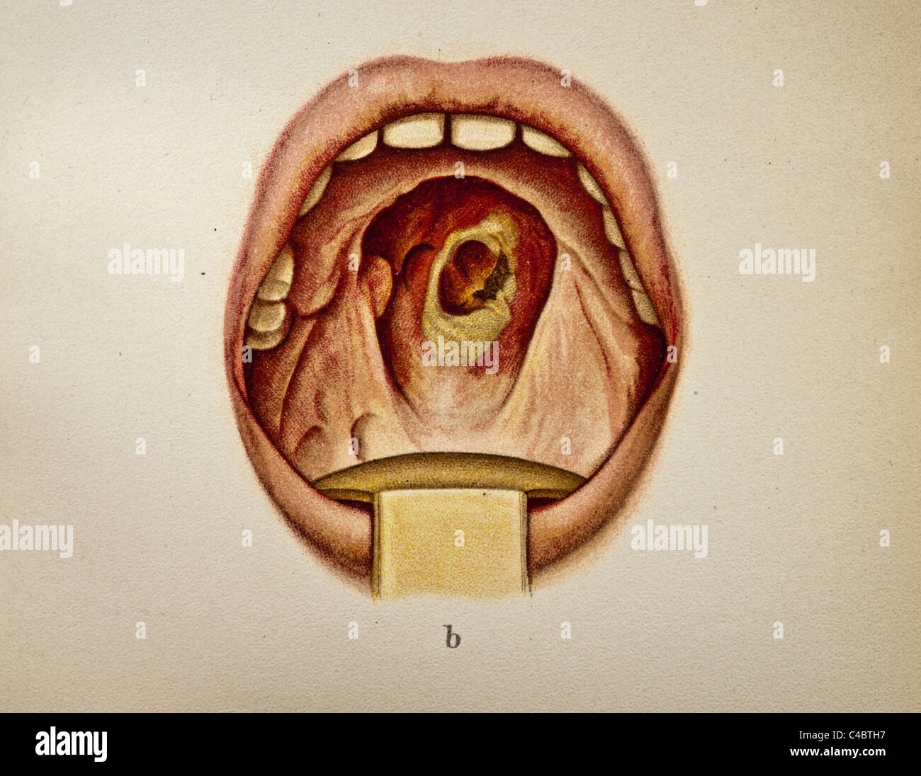 Illustration of Gumma in the Human Mouth copyright 1898 Stock Photo