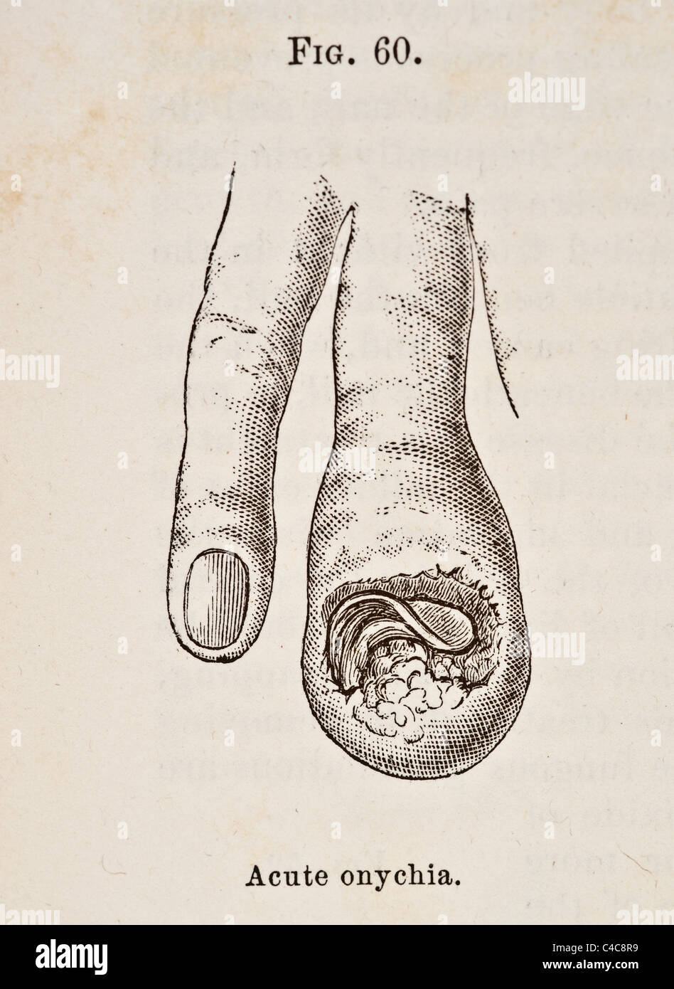 Antique Medical Illustration of Affections of the Nails circa 1881 Stock Photo