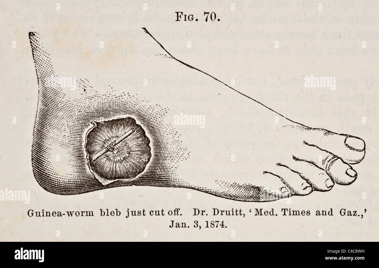 Antique Medical Illustration of Guinea-Worm Bleb circa 1881 Stock Photo