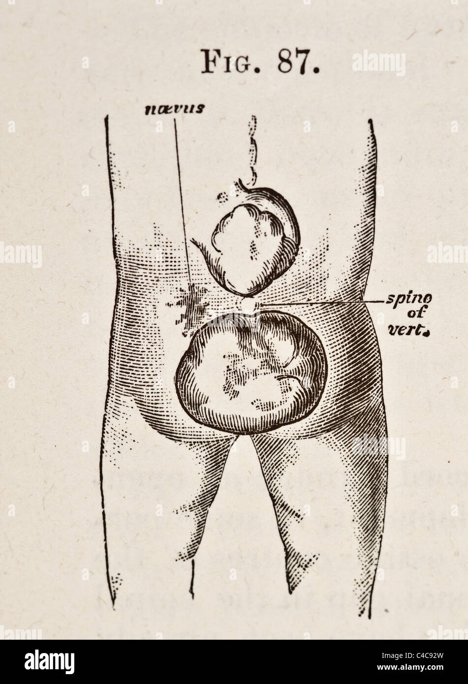 Antique Medical Illustration Depicting Spina Bifida circa 1881 Stock Photo