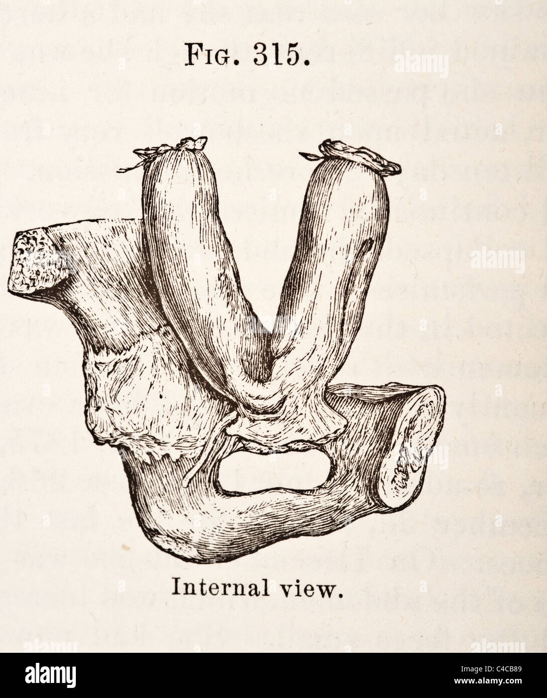 Antique Medical Illustration Depicting Hernia circa 1881 Stock Photo