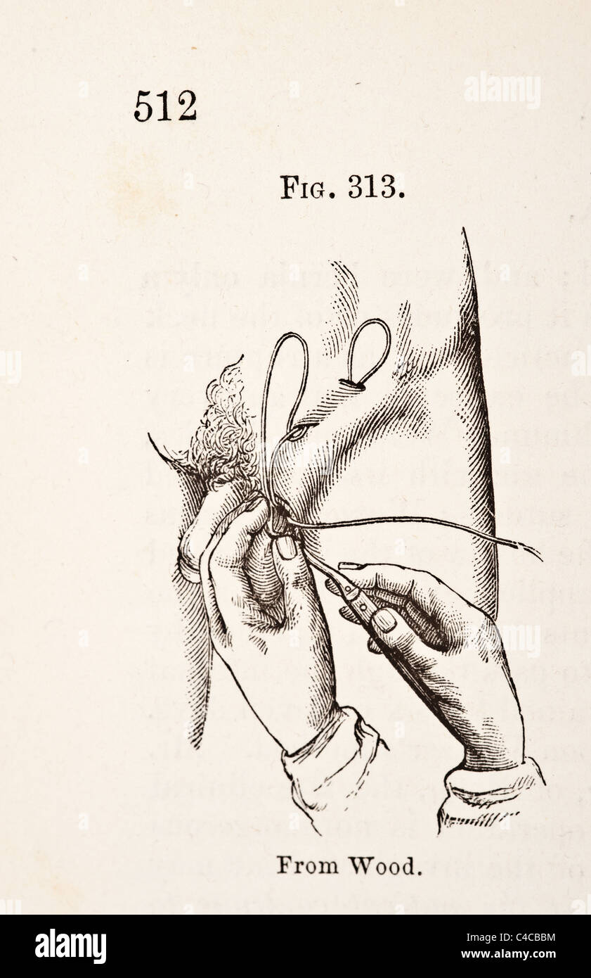 Antique Medical Illustration Depicting Hernia circa 1881 Stock Photo