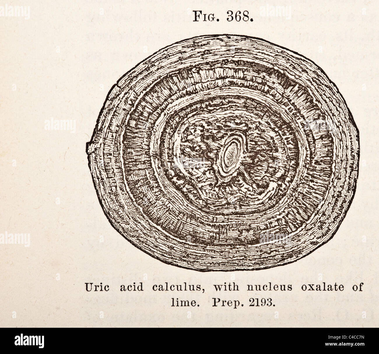 Antique Medical Illustration of Urinary Calculi (Kidney Stones) circa ...