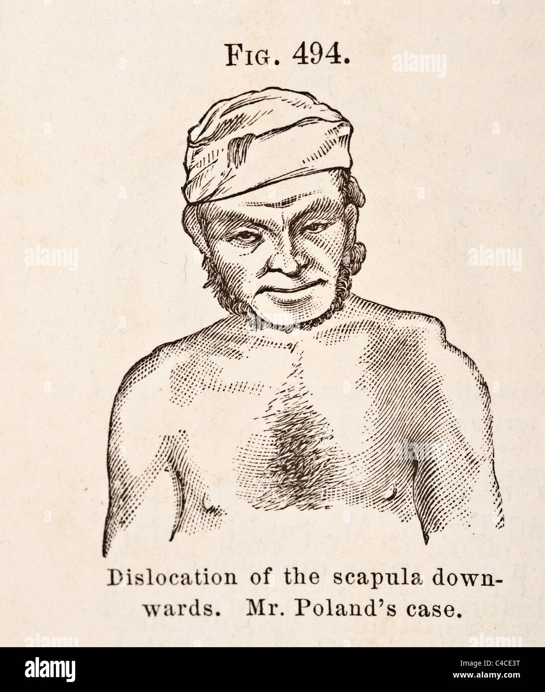 Antique Medical Illustration Depicting Dislocation of Scapula and Clavicle Stock Photo