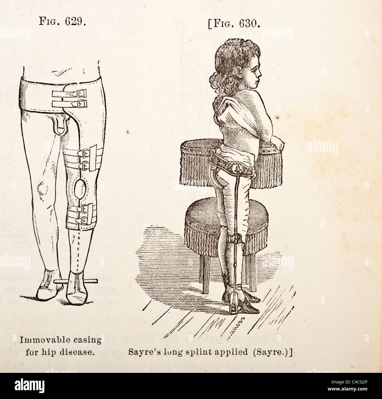 Antique Medical Illustration of Treatment for Hip-Joint Disease Stock Photo