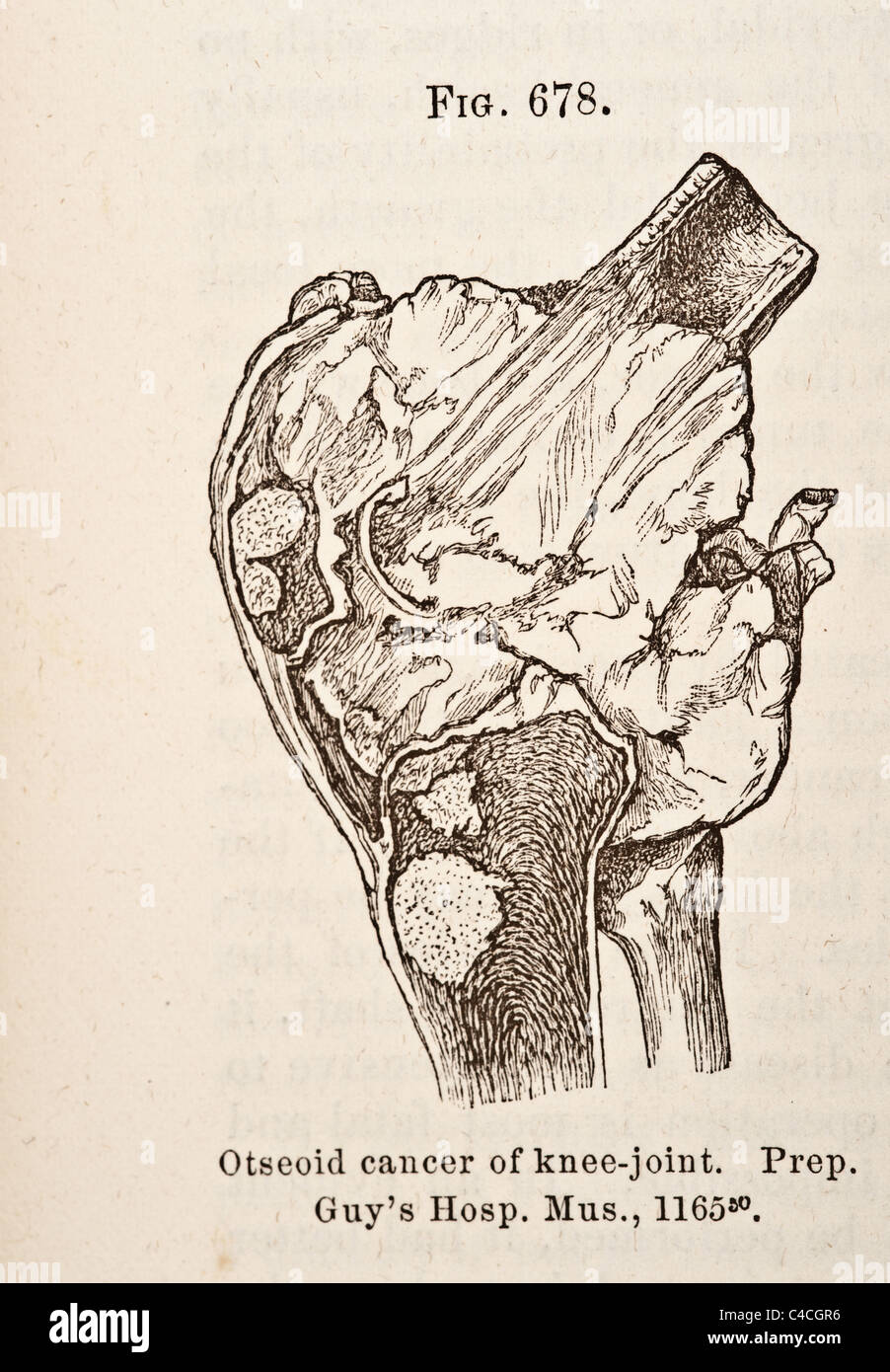 Antique Medical Illustration of Tumors of Bone circa 1881 Stock Photo