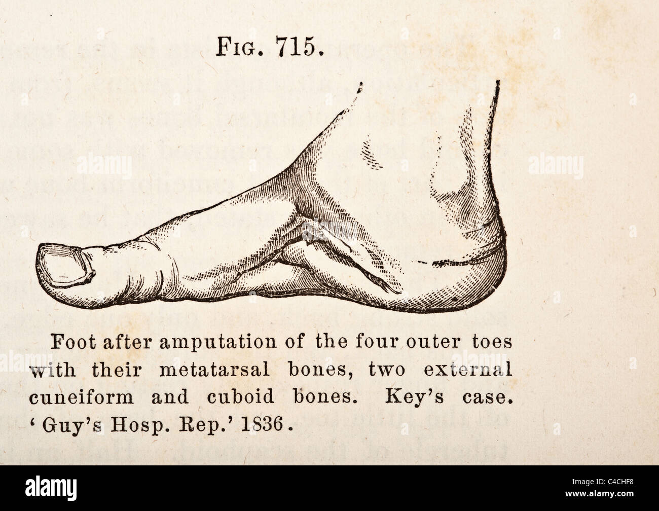 Antique Medical Illustration of Amputation(s) Procedure circa 1881 ...