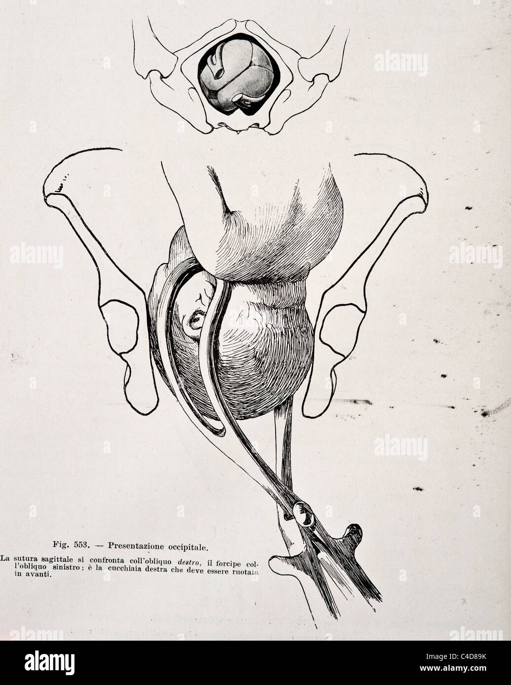 Illustration of Human Birth copyright 1905 Stock Photo