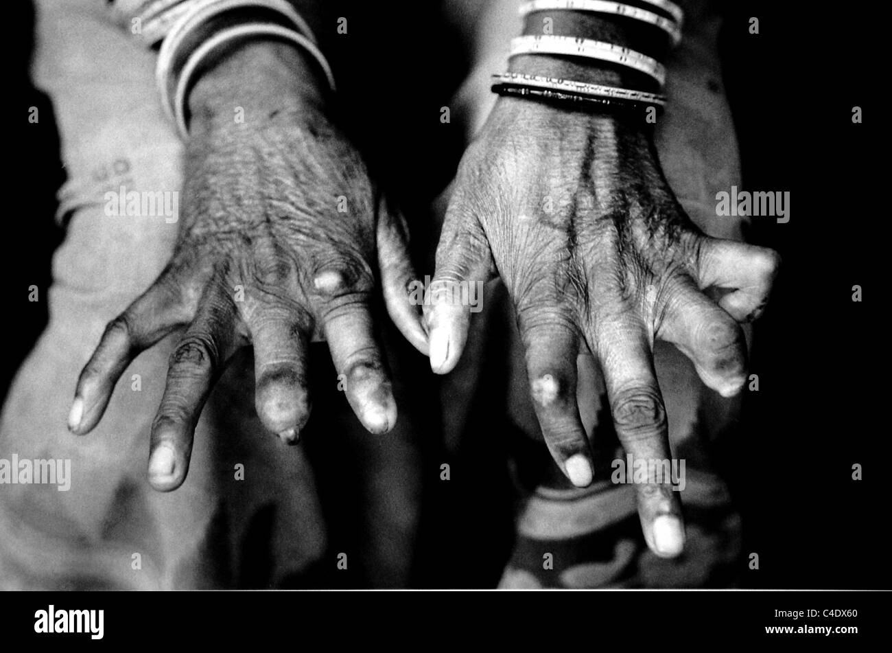 a victim of leprosy holds out their hands at the Oxfam sponsored SOLAR agency in Puri in the Orissa region of India 1991 Stock Photo