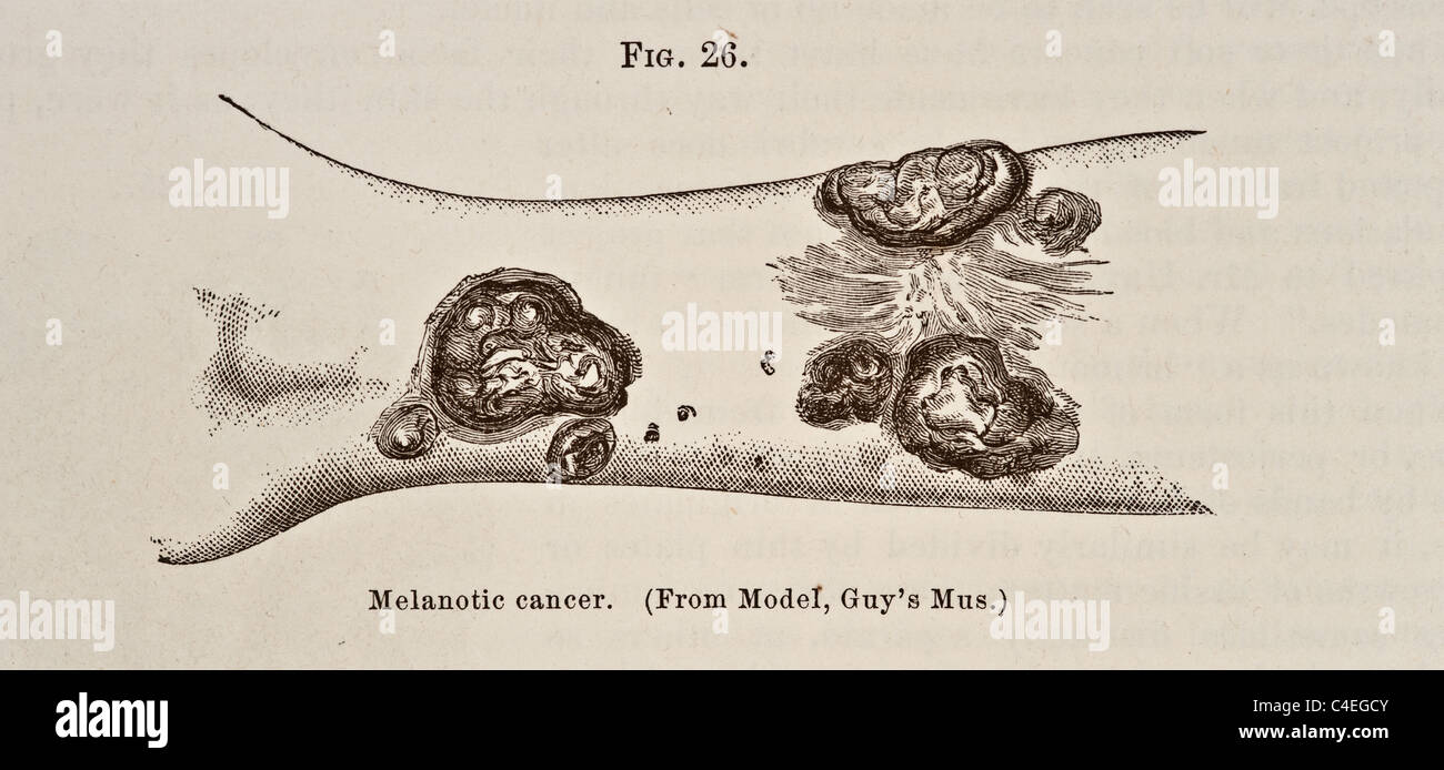 Antique Medical Illustration of Melanotic Cancer circa 1881 Stock Photo