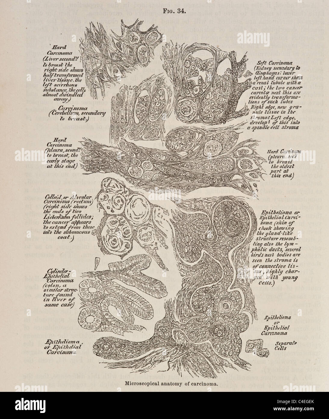 Antique Illustration of Microscopical Anatomy of Carcinoma circa 1881 Stock Photo