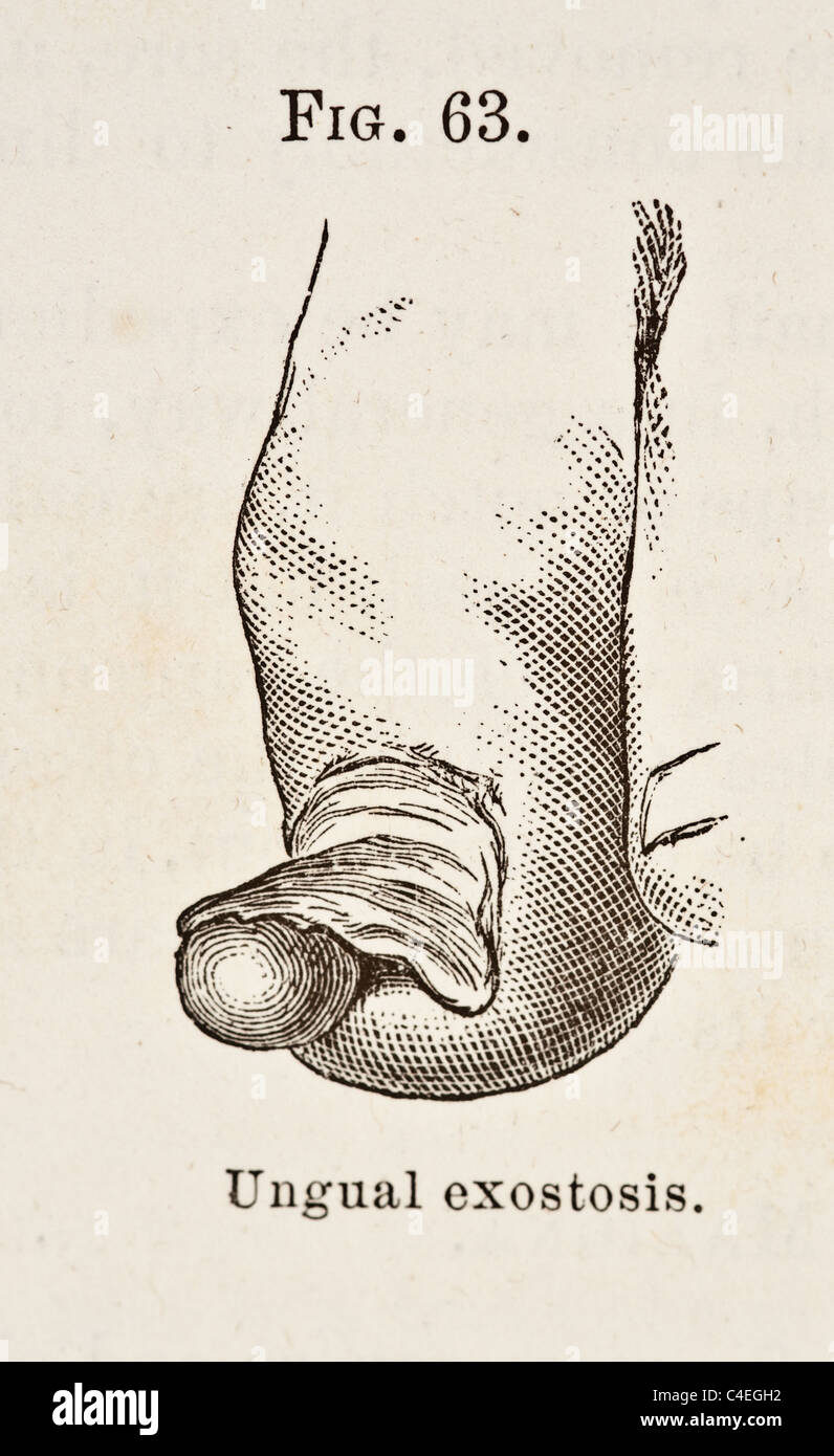 Antique Medical Illustration of Ungual Exostosis circa 1881 Stock Photo