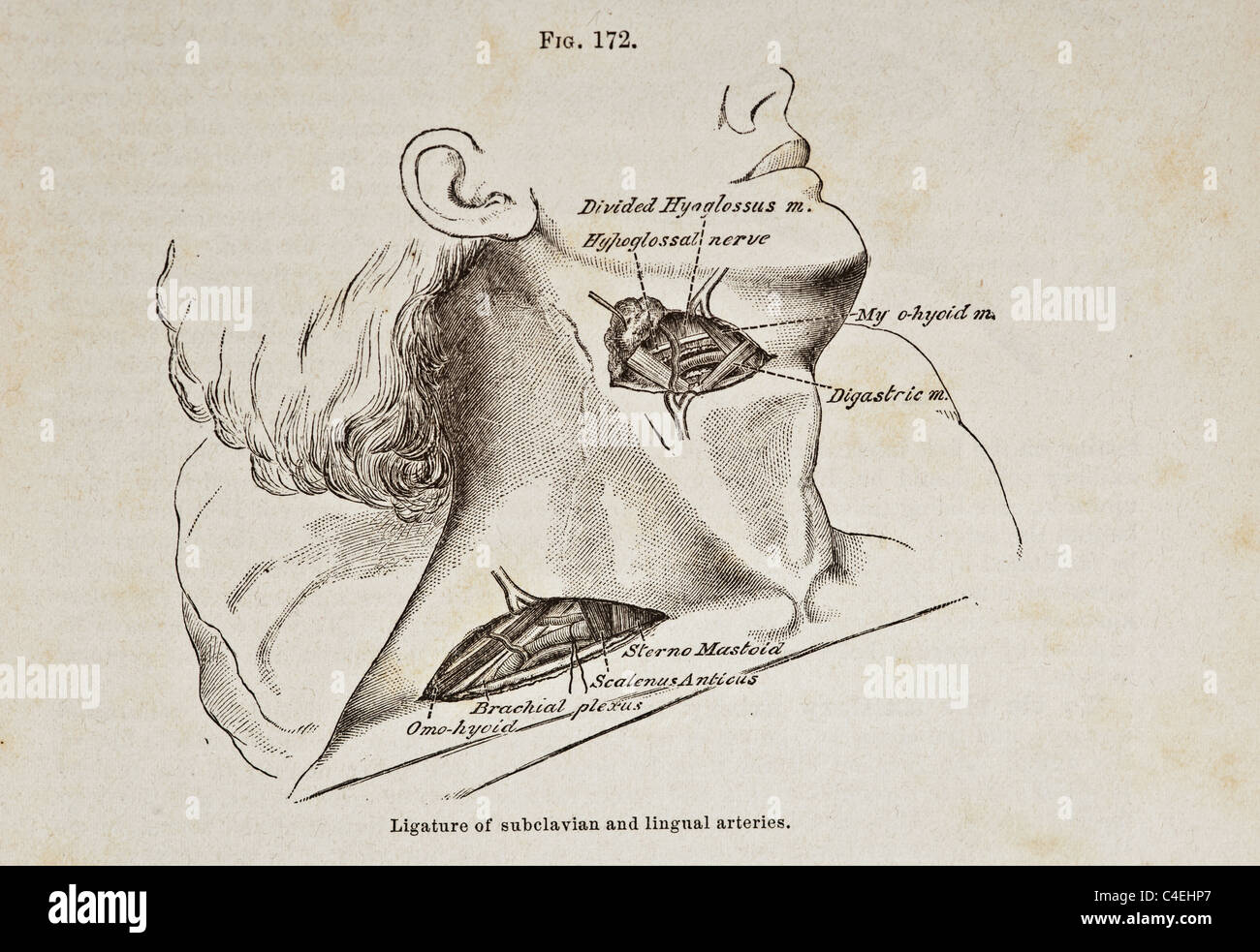 Antique Medical Illustration of Ligature of Subclavian and Lingual Arteries circa 1881 Stock Photo