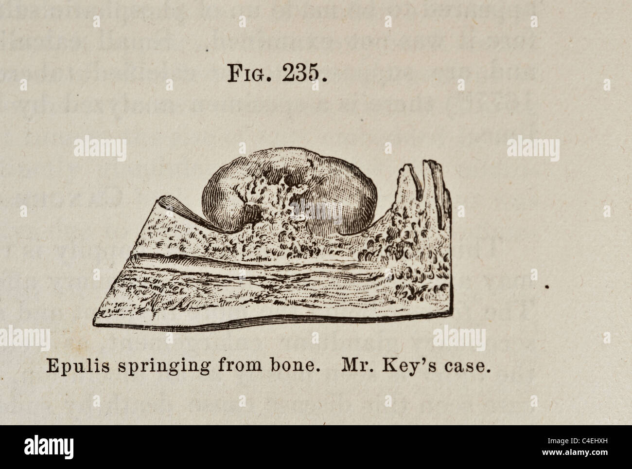 Antique Medical Illustration of Epulis Springing From Bone circa 1881 Stock Photo