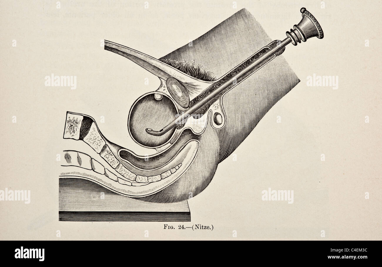 Genito-Urinary Diseases Syphilology and Dermatology copyright 1893 Stock Photo