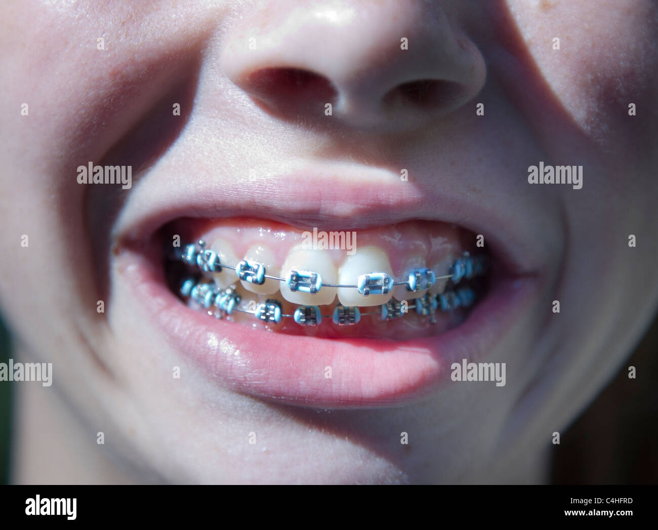 13 year old girl braces hires stock photography and images Alamy