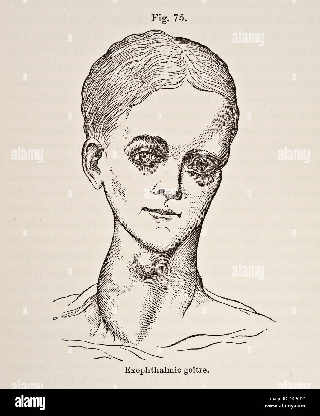 Goitre thyroid hi-res stock photography and images - Alamy