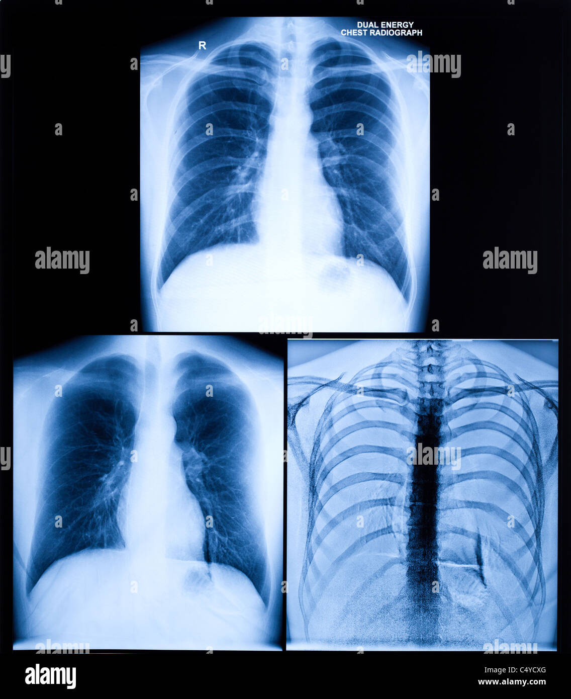 X-Ray Image Of Human Healthy Chest Stock Photo