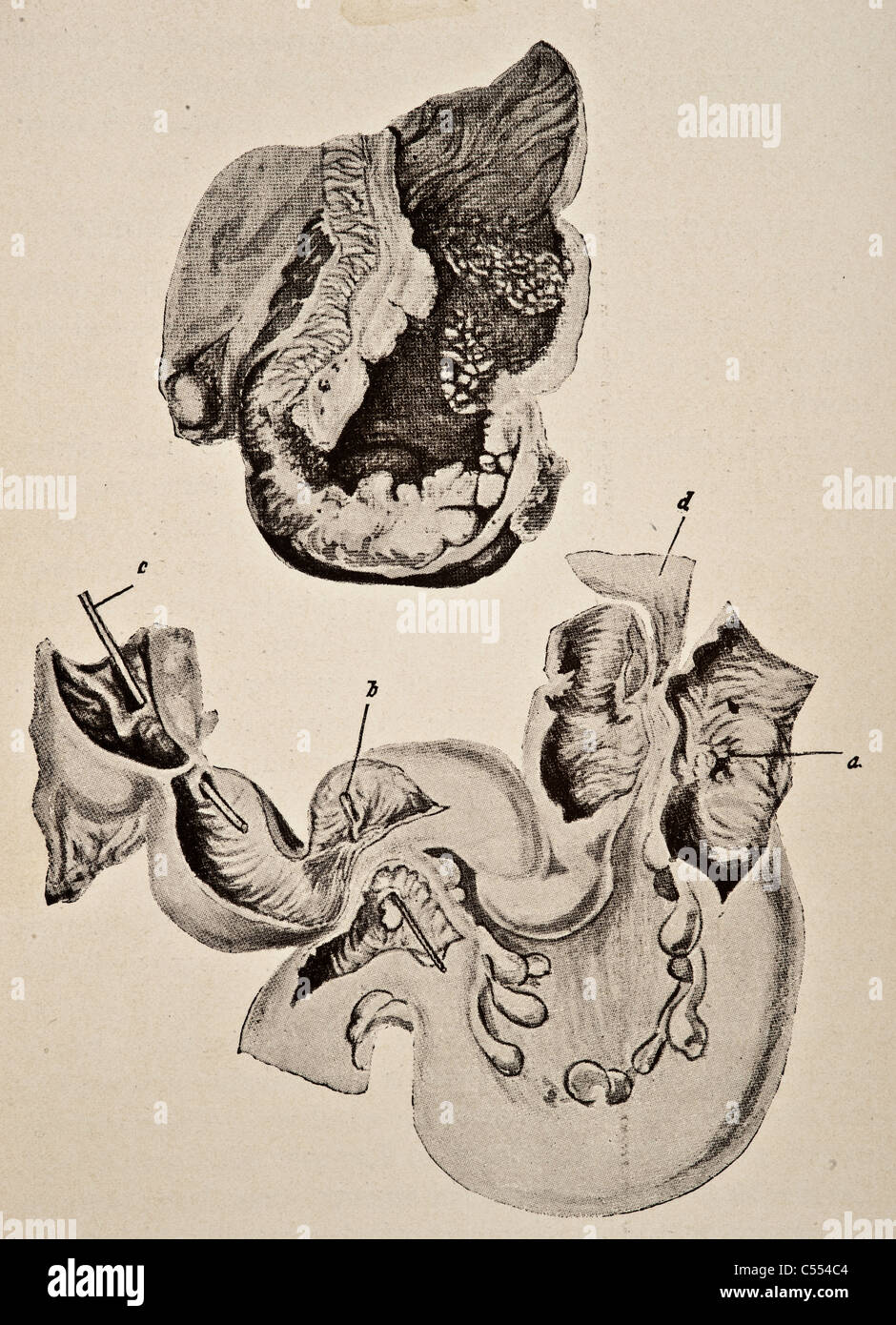 Anatomy of Intestinal Diseases including Cancer Stock Photo