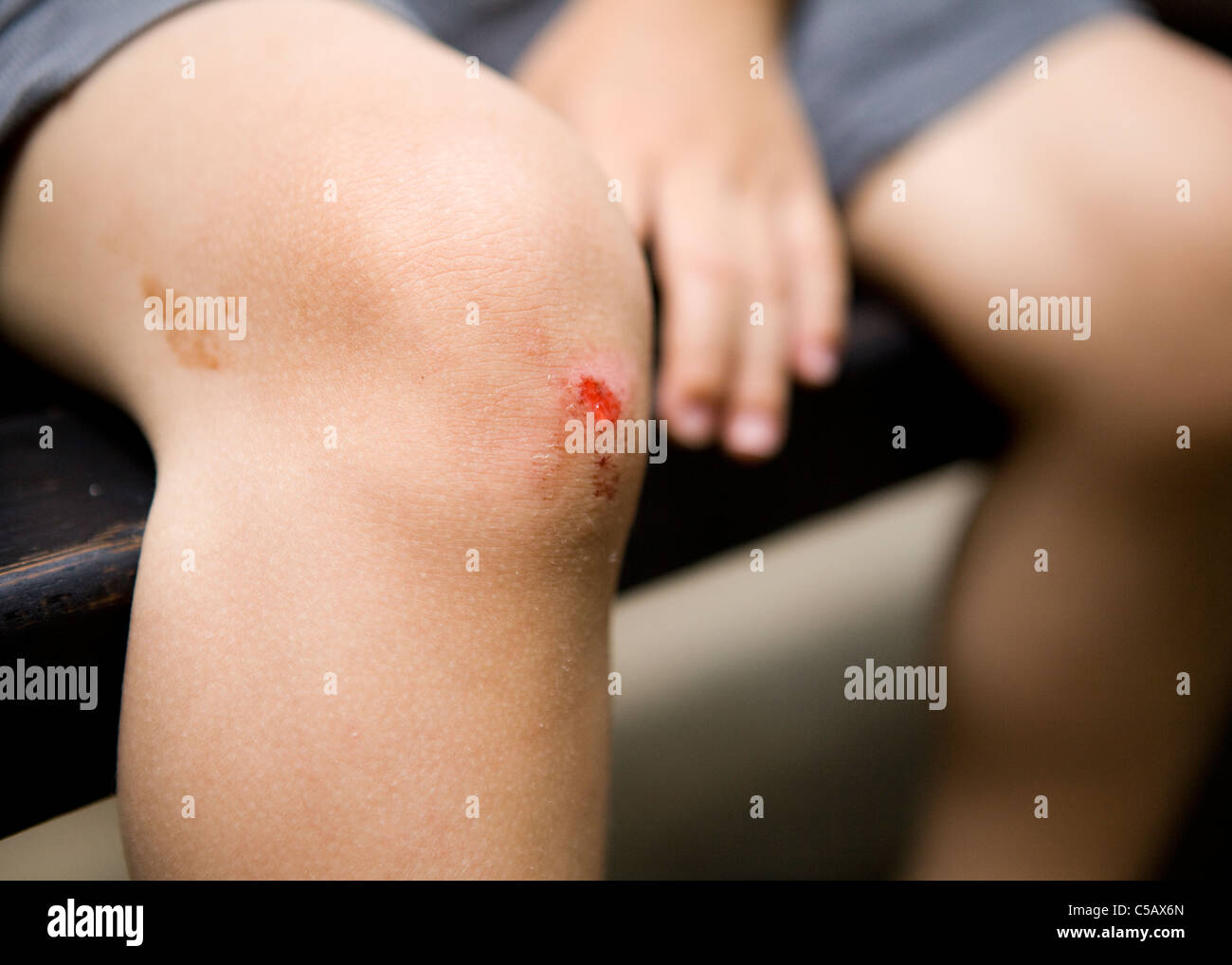 Page 2 - Skinned Knee High Resolution Stock Photography and Images - Alamy Page 2 - Skinned Knee High Resolution Stock Photography and Images - Alamy
