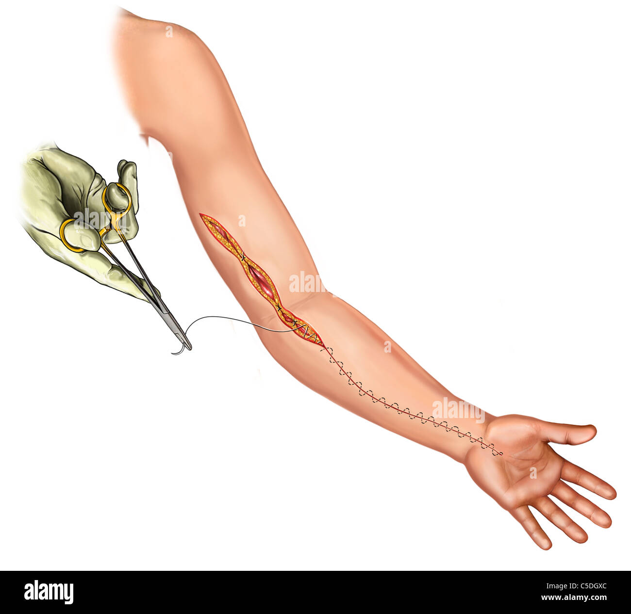 Fasciotomy hires stock photography and images Alamy