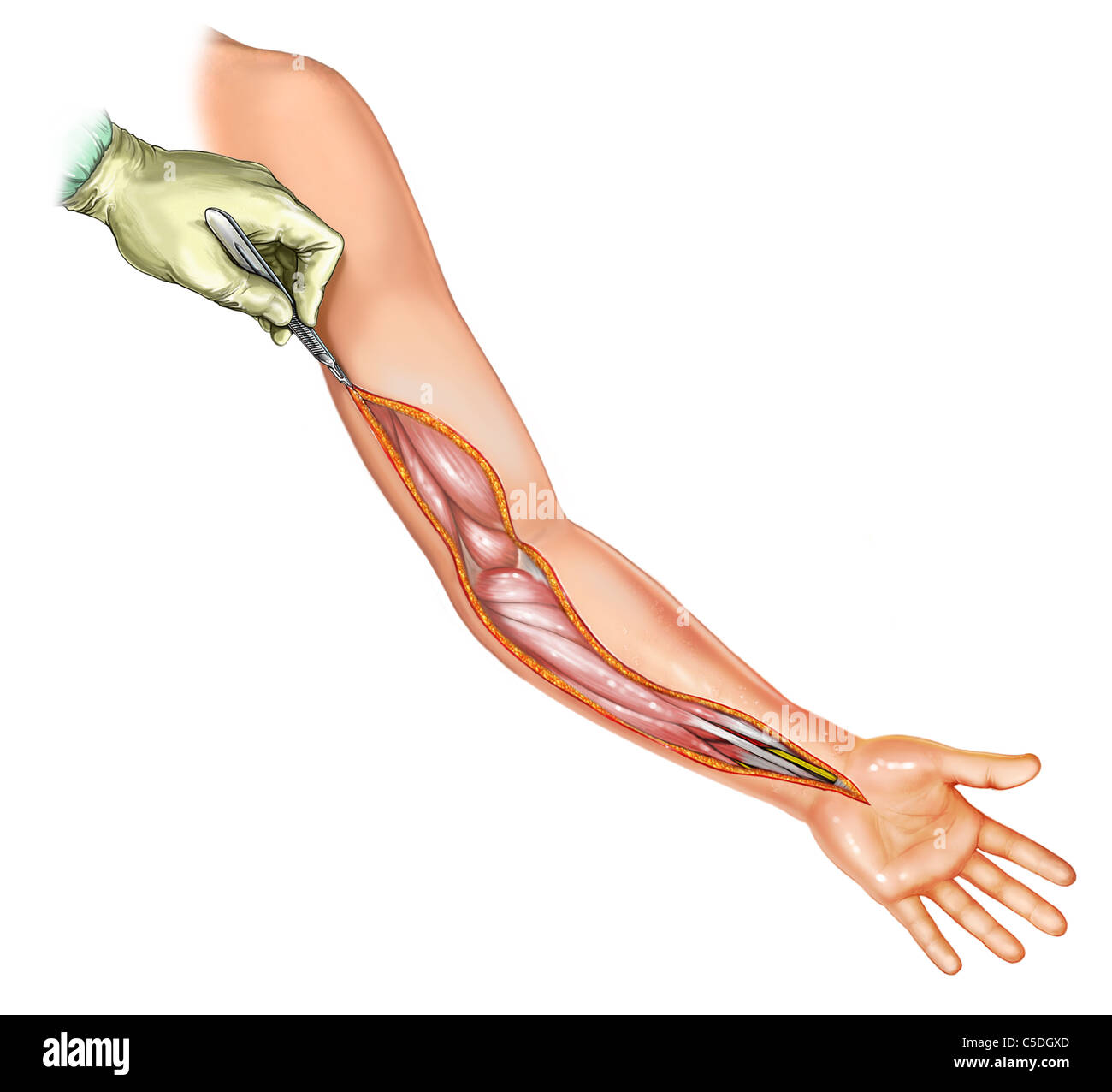 Compartment Syndrome of Arm Stock Photo