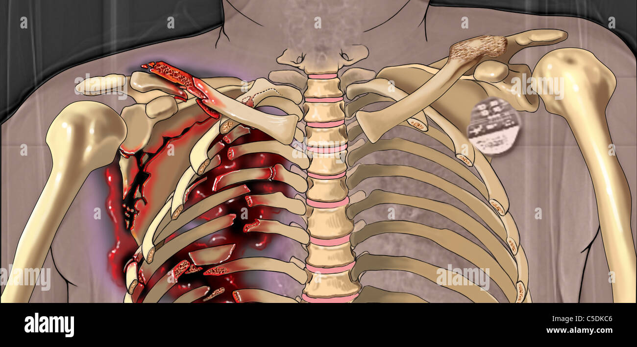 Color interpretation of x-ray film showing clavicle, scapula and multiple rib fractures Stock Photo