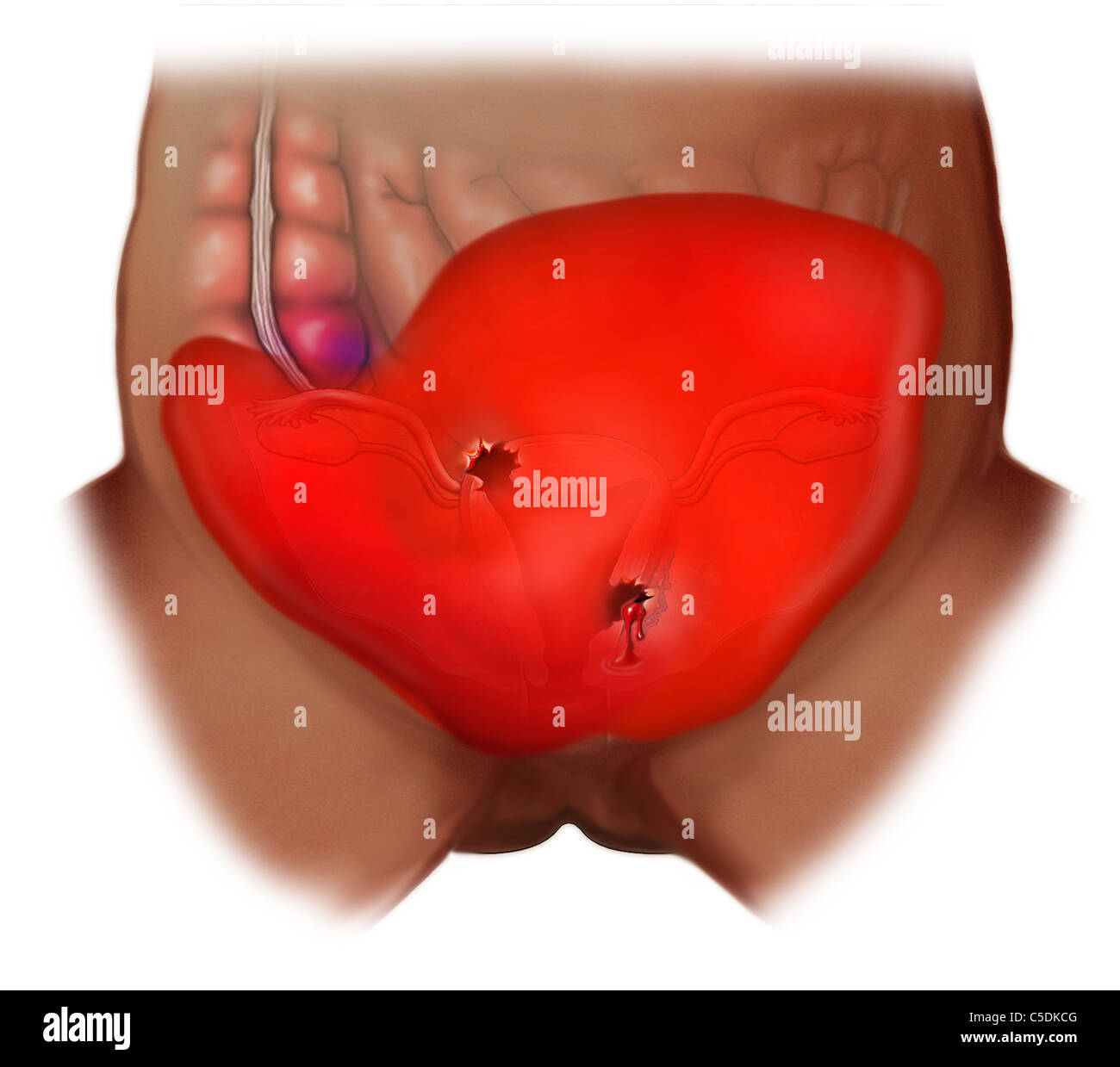 Perforated Uterus and Hemorrhage Stock Photo