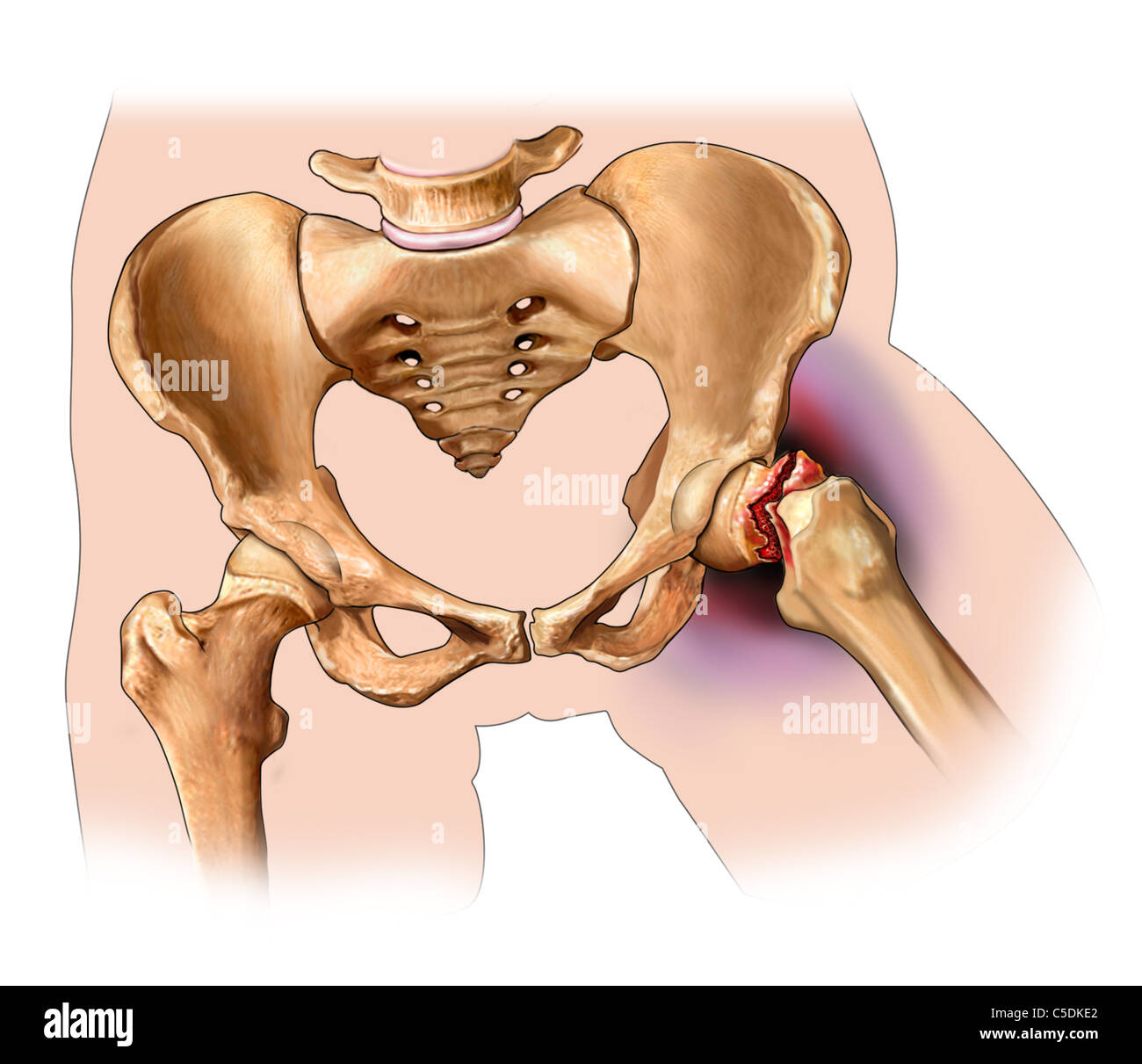 Femoral neck fracture Stock Photo
